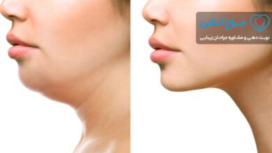 جراحی رفع غبغب چیست + هزینه