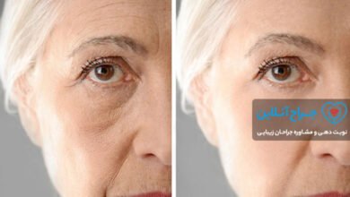 همه چیز در مورد تزریق چربی + هزینه