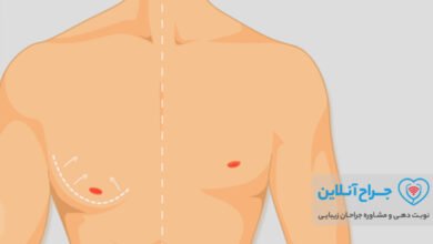 بهترین دکتر کوچک کردن سینه در مردان (ژنیکوماستی) در تهران+ هزینه و نمونه کار