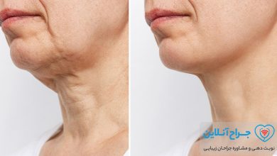 بهترین دکتر لیفت گردن در تهران + هزینه و نمونه کار
