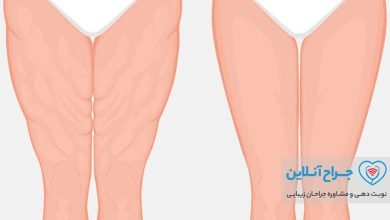 بهترین دکتر جراحی لیفت ران در تهران+ هزینه و نمونه کار