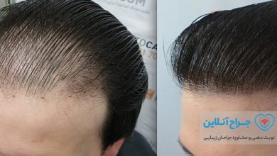 بهترین کلینیک کاشت مو در تهران + هزینه و نمونه کار