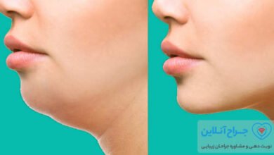 بهترین دکتر رفع غبغب در تهران + هزینه و نمونه کار