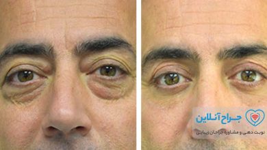 بهترین دکتر جراحی زیبایی پلک (بلفاروپلاستی) در تهران + هزینه و نمونه کار