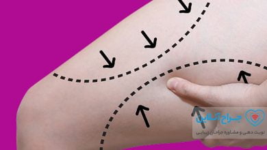 همه چیز در مورد جراحی لیفت ران + هزینه