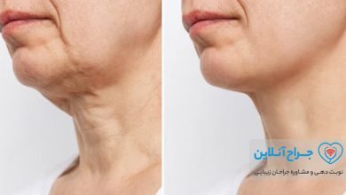 همه چیز در مورد لیفت گردن + هزینه