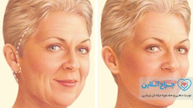 همه چیز در مورد جراحی لیفت صورت + هزینه لیفت صورت