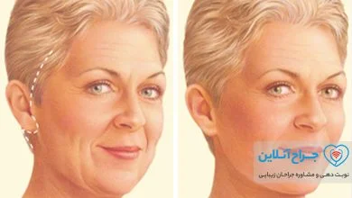 همه چیز در مورد جراحی لیفت صورت + هزینه لیفت صورت