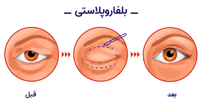 همه چیز در مورد جراحی زیبایی پلک ( بلفاروپلاستی ) + هزینه 