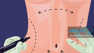 بهترین جراح لیپوماتیک در اردبیل